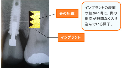 インプラントのの表面の細かい溝に、骨の細胞が隙間なく入り込んでいる様子。