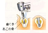 1次手術