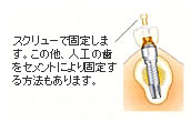 人工歯を作成、装着